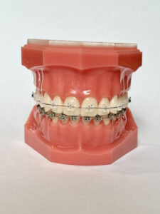 Ceramic Braces: Are They Right For You? Artistic Dental at the