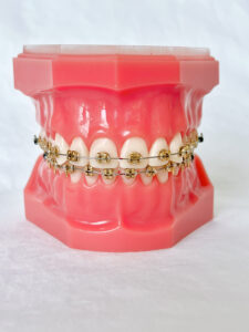 Types of Braces in Salem & Keizer OR - McDonald Orthodontics